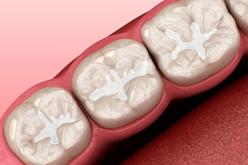 Dental Sealants in El Paso